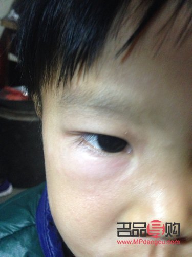 下眼袋處腫了像蚊子包怎么辦(下眼袋處腫了像蚊子包怎么辦用什么藥)