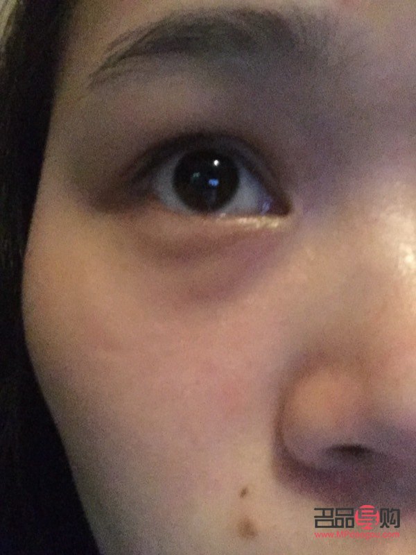 下眼袋處腫了像蚊子包怎么辦(下眼袋處腫了像蚊子包怎么辦用什么藥)