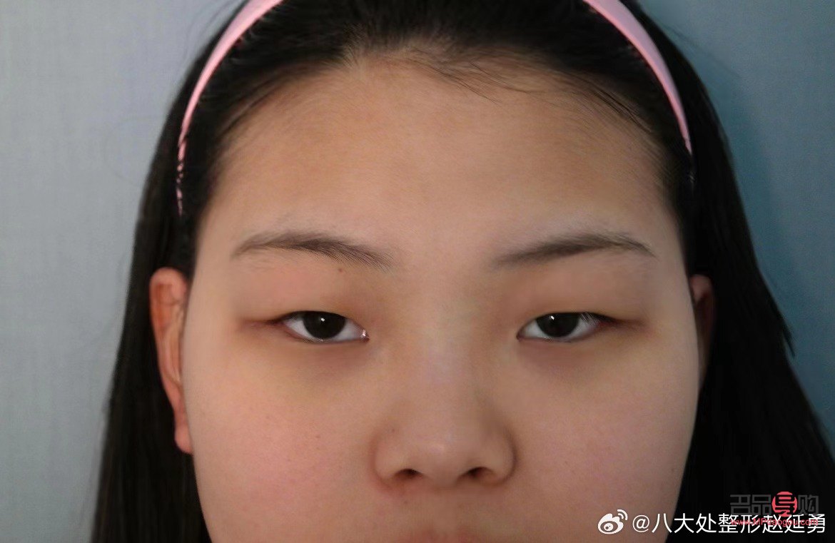 <h3>腫眼泡手術(shù)后是否會(huì)再次復(fù)發(fā)？</h3>