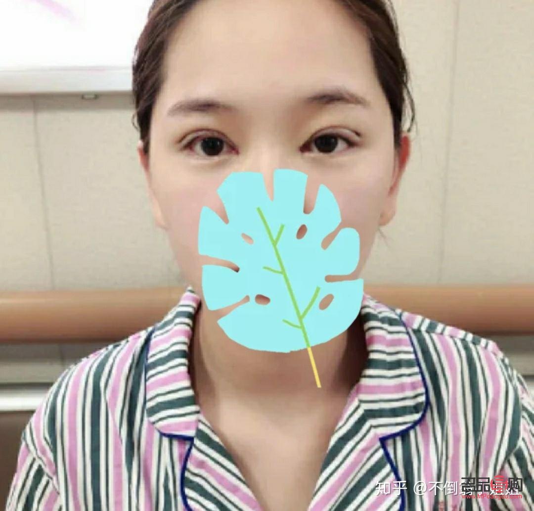 <h3>腫眼泡手術(shù)后是否會(huì)再次復(fù)發(fā)？</h3>