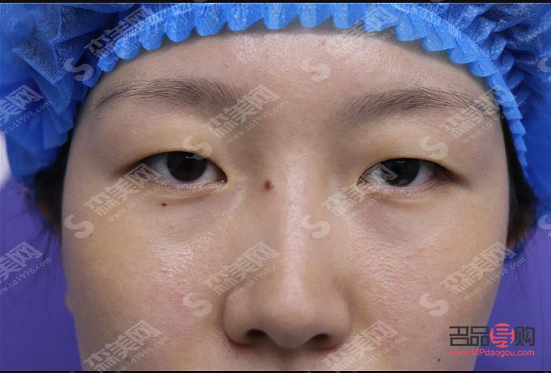 腫眼泡手術(shù)后是否會再次復(fù)發(fā)？