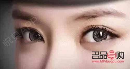 雙眼皮美學：探索最受歡迎的雙眼皮款式