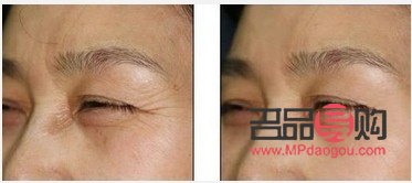 眼睛下面皺紋怎么去除最有效果呢(眼睛下面皺紋怎么去除最有效果呢視頻)