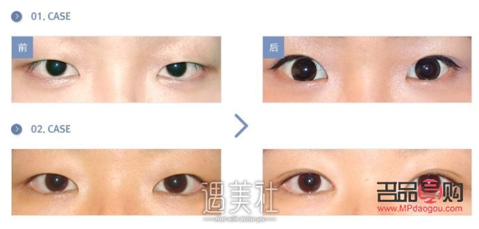 <h1>內(nèi)眼角開太大了怎么辦？專業(yè)解答與應(yīng)對策略</h1>