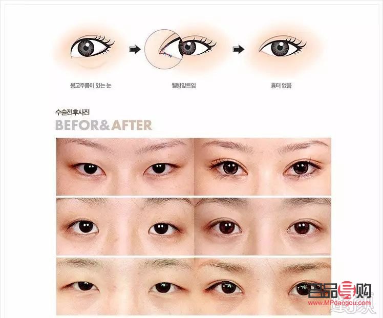 哪種眼睛適合開外眼角