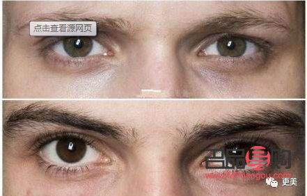 解決眼窩凹陷的最佳方法