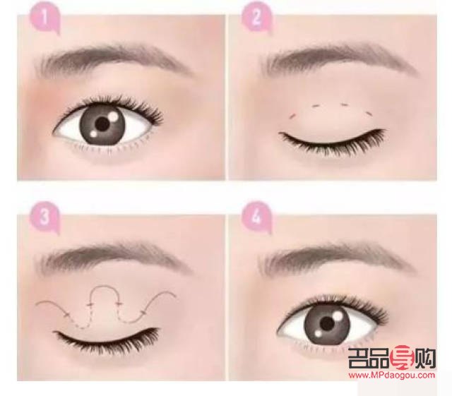 什么叫假性雙眼皮(什么叫假性雙眼皮手術(shù))