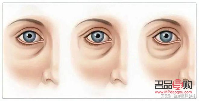 不開刀去眼袋有幾種方法(不開刀去眼袋有幾種方法視頻)