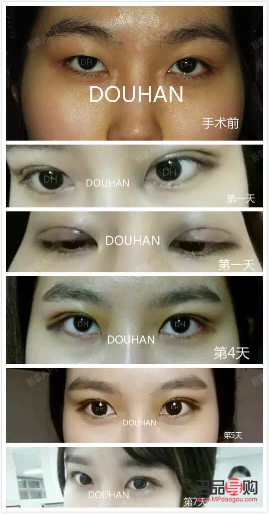 <h3>雙眼皮是什么眼睛</h3>