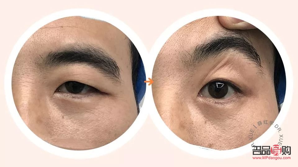 做雙眼皮提肌與不提肌的區(qū)別案例(雙眼皮提肌和不提肌的圖片對比)