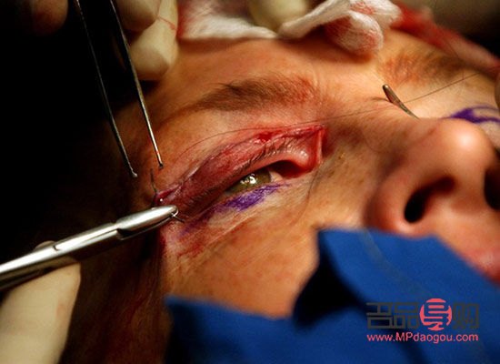 眼睛動(dòng)手術(shù)全過(guò)程解析