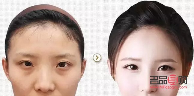 內(nèi)雙適不適合割雙眼皮(內(nèi)雙適不適合割雙眼皮手術(shù))