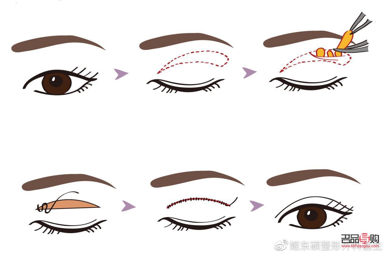 雙眼皮眼皮松弛下垂最好解決方法(雙眼皮眼皮松弛下垂最好解決方法是什么)