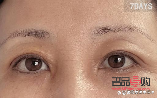 雙眼皮眼皮松弛下垂最好解決方法(雙眼皮眼皮松弛下垂最好解決方法是什么)