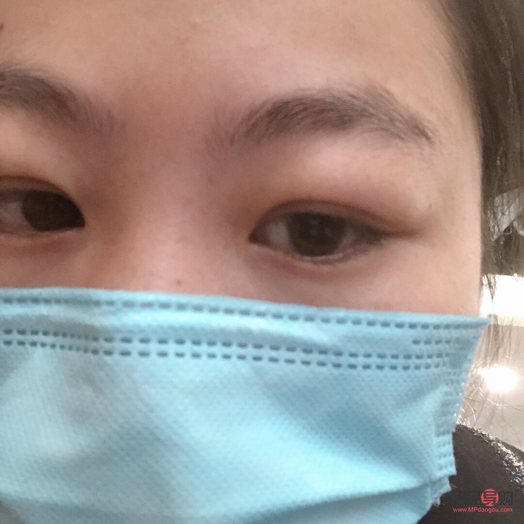 天生腫眼泡熱敷是否有用？