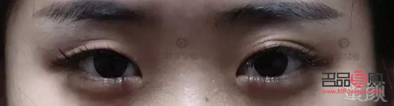 <h3>大小眼手術(shù)失?。涸?、影響與應(yīng)對(duì)策略</h3>