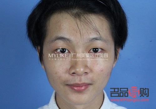 <h3>大小眼手術(shù)失?。涸?、影響與應(yīng)對(duì)策略</h3>