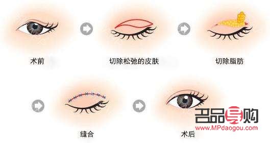 眼皮下垂最好解決方法百度知道(眼皮下垂的治療方法)