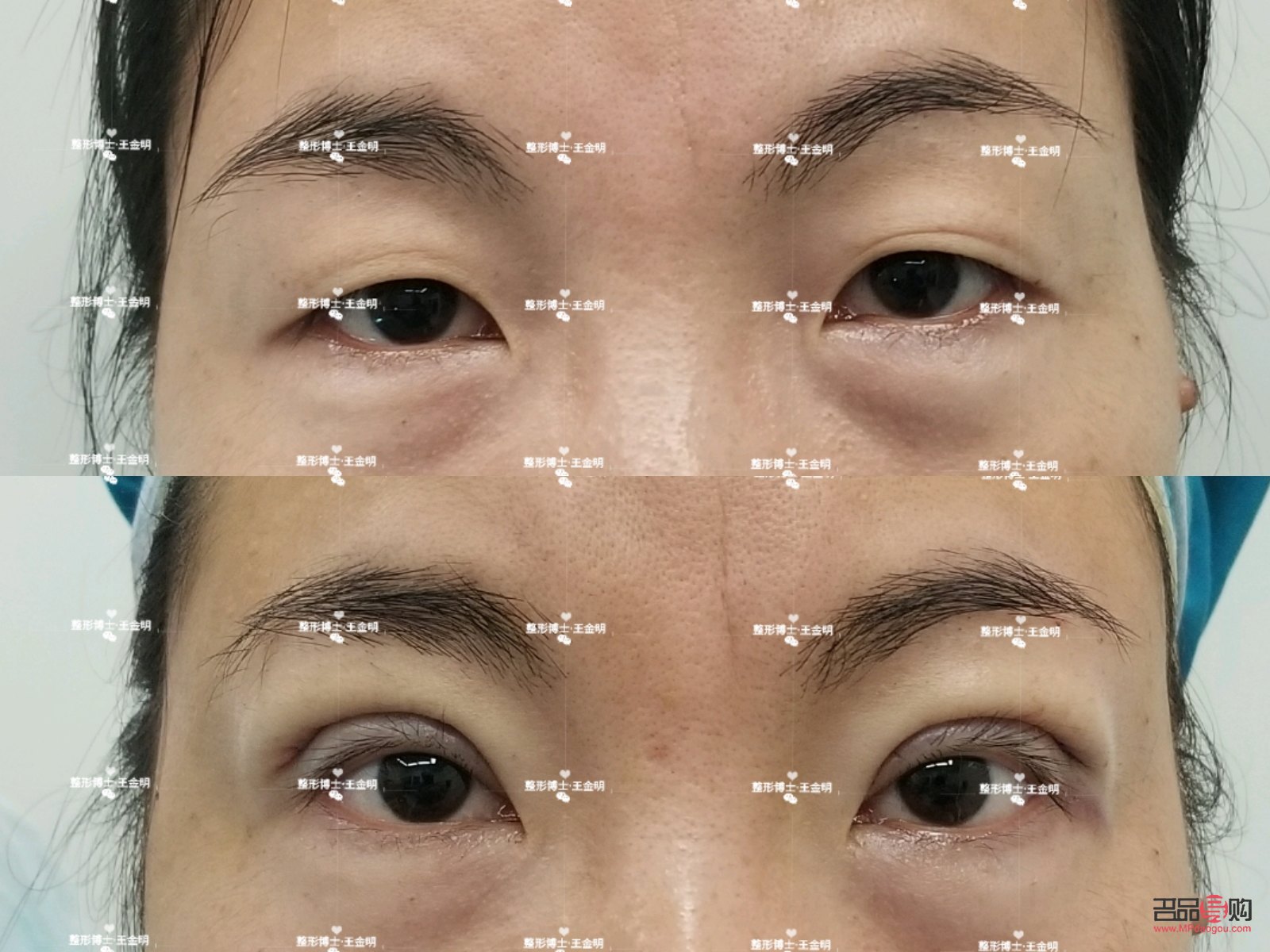 大小眼手術(shù)(大小眼手術(shù)多久恢復(fù))