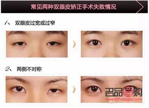 大小眼手術(shù)(大小眼手術(shù)多久恢復(fù))