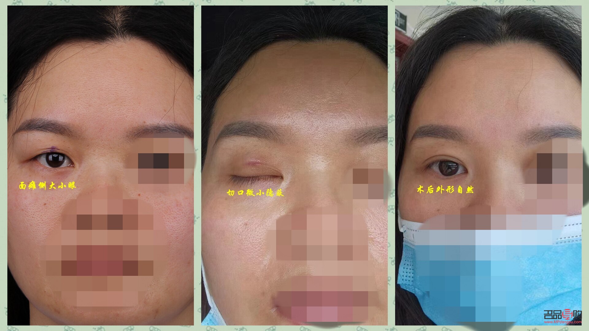 大小眼手術(shù)(大小眼手術(shù)多久恢復(fù))