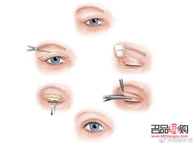 <h3>雙眼皮太寬能否改窄？專業(yè)解答與操作建議</h3>