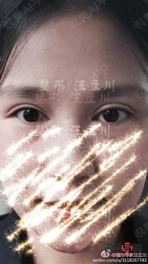 雙眼皮太寬能否改窄？專業(yè)解答與操作建議