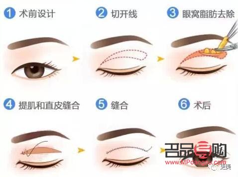 雙眼皮簡約天花效果圖多少錢一個(雙眼皮天花價格)