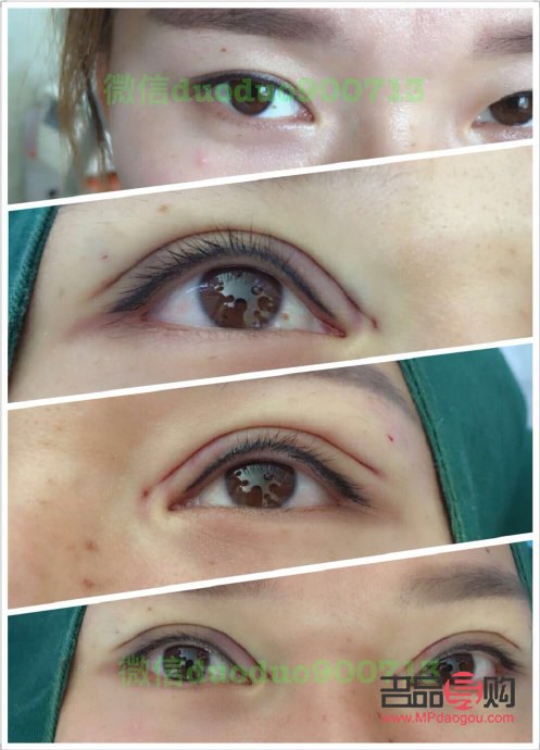 芭比眼綜合多久能恢復好一點(芭比眼綜合恢復過程)