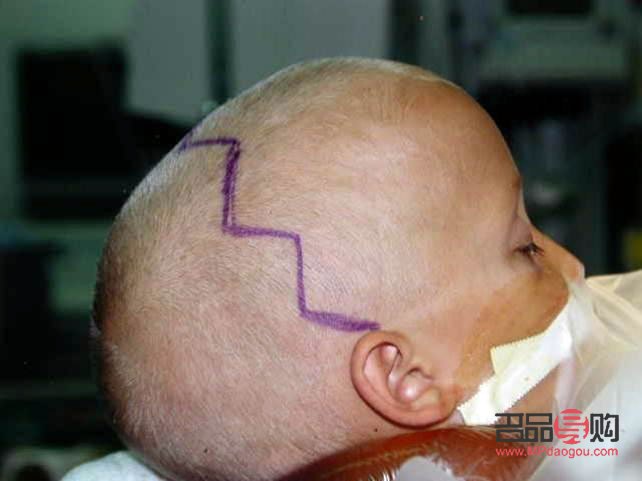 <h3>顱縫早閉與大小眼的關(guān)系探究</h3>