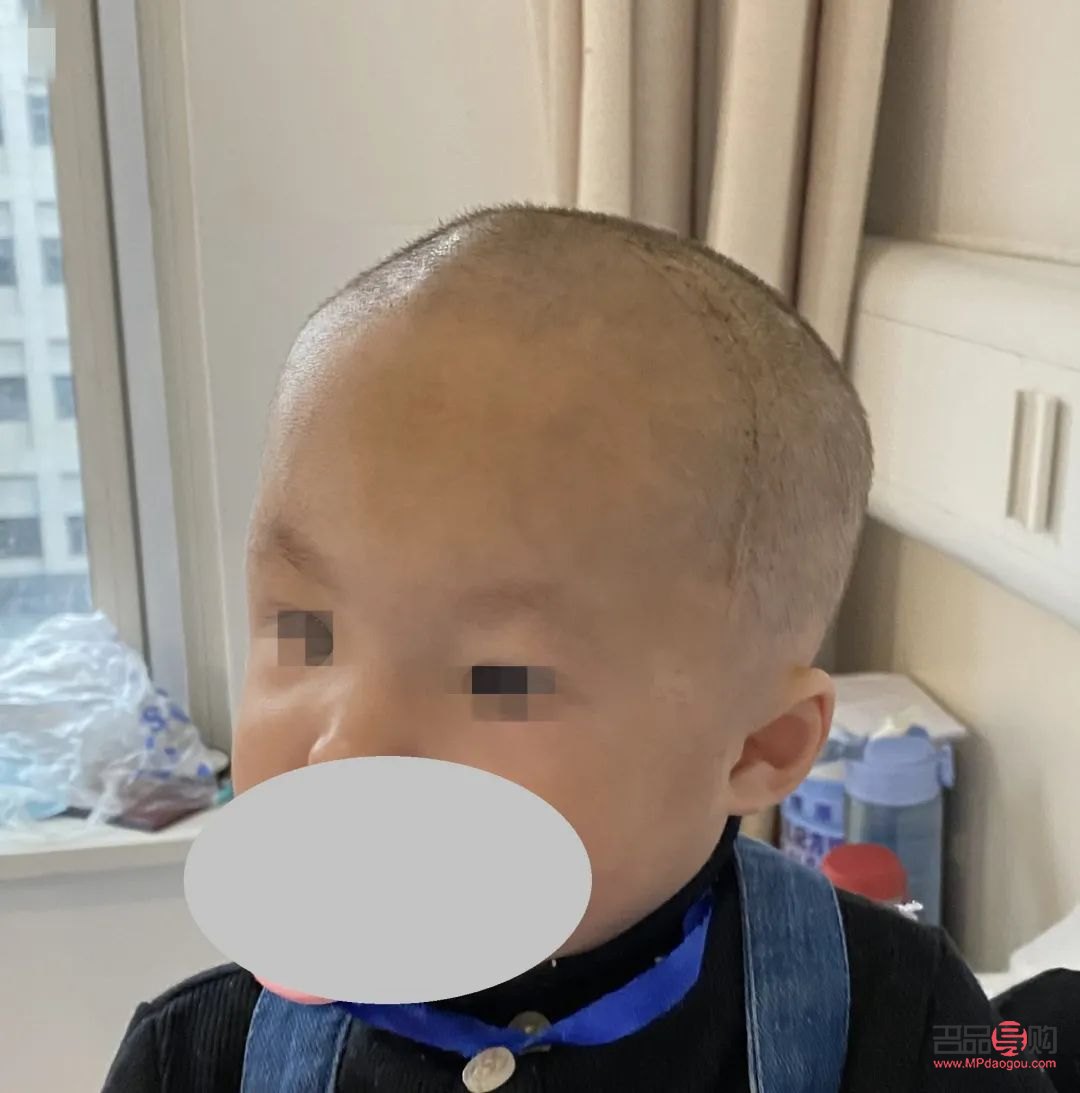 <h3>顱縫早閉與大小眼的關(guān)系探究</h3>