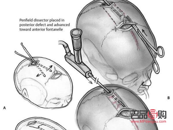 <h3>顱縫早閉與大小眼的關(guān)系探究</h3>
