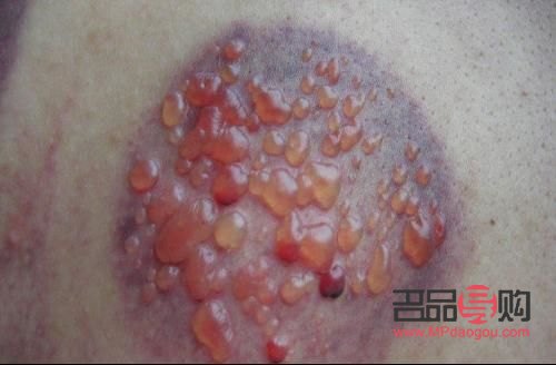 做身體護理有水泡嗎(做身體護理有水泡嗎怎么辦)