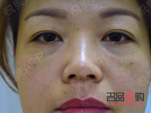 <h3>內(nèi)切祛眼袋手術(shù)效果能持續(xù)多久？</h3>