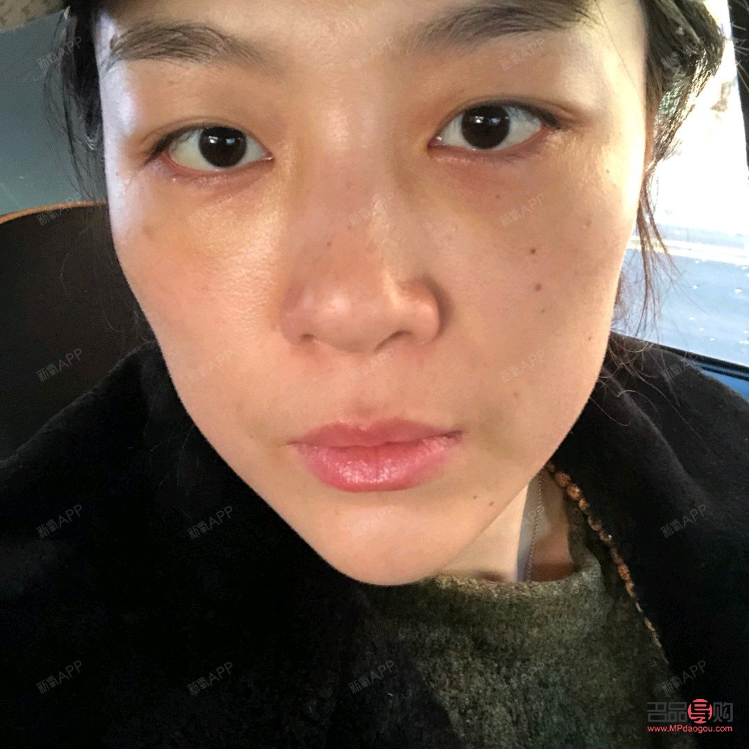 <h3>內(nèi)切祛眼袋手術(shù)效果能持續(xù)多久？</h3>