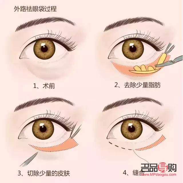 <h3>醫(yī)美去眼袋手術(shù)可能帶來的后遺癥</h3>
