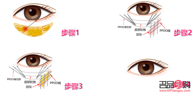 <h3>醫(yī)美去眼袋手術(shù)可能帶來的后遺癥</h3>