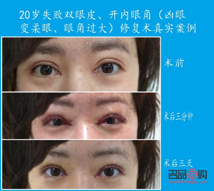 開眼角割雙眼皮恢復(fù)期詳解