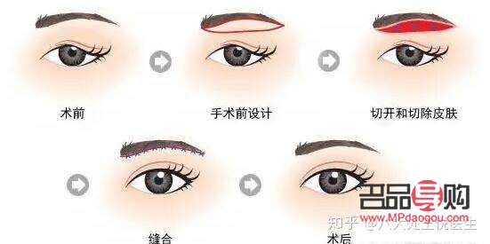 上眼皮松了可以割雙眼皮嗎(上眼皮松了可以割雙眼皮嗎視頻)