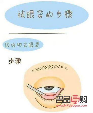 <h3>探究眼袋內(nèi)切手術(shù)的費(fèi)用及相關(guān)因素</h3>