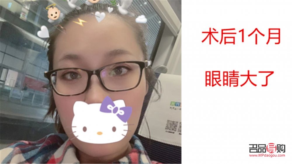 <h3>天生眼泡腫怎么辦？有效緩解眼泡腫脹的方法與建議</h3>