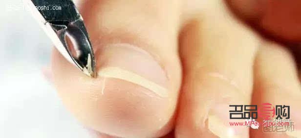 怎么做腳趾美容針(腳趾美容整形)