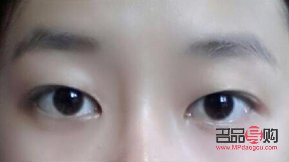 <h3>眼睛內(nèi)雙的女生可以做雙眼皮手術(shù)嗎？</h3>