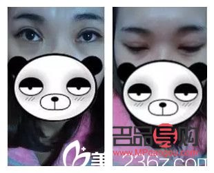 <h3>開(kāi)眼角雙眼皮手術(shù)恢復(fù)自然所需時(shí)間探究</h3>