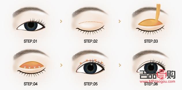 <h3>開(kāi)眼角雙眼皮手術(shù)恢復(fù)自然所需時(shí)間探究</h3>