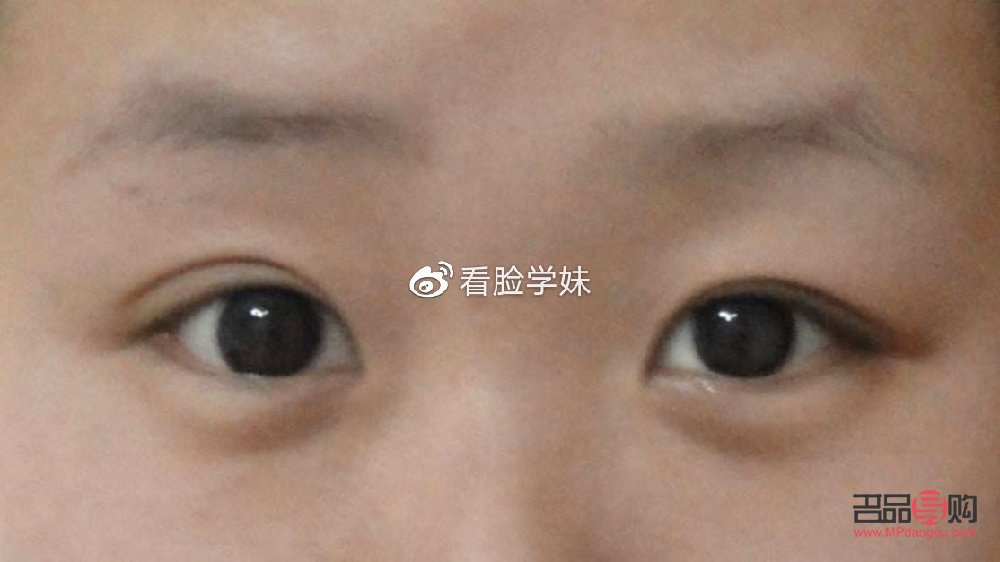 <h3>兩個(gè)眼皮雙的不一樣怎么辦</h3>