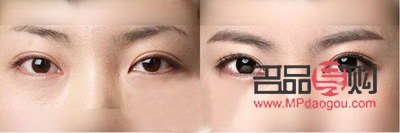 <h3>兩個(gè)眼皮雙的不一樣怎么辦</h3>