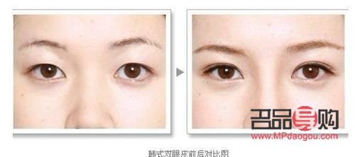 納米無痕雙眼皮屬于埋線嗎(納米無痕雙眼皮屬于埋線嗎還是全切)