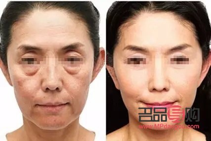 美容臉部提升好嗎(美容里面的臉部提升)