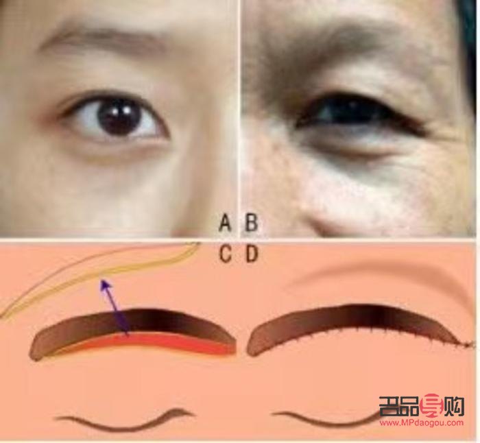 重塑青春明眸：探索眼皮下垂恢復(fù)之道